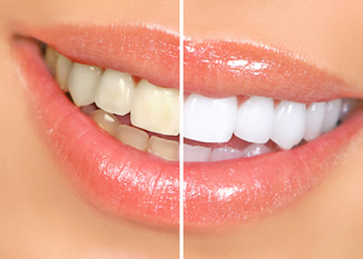 Smile with glitter gloss that’s halved to show results of teeth whitening