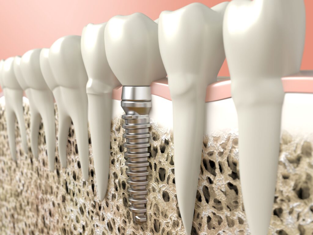 Rendering of a dental implant in a lower arch with other teeth with a peach background