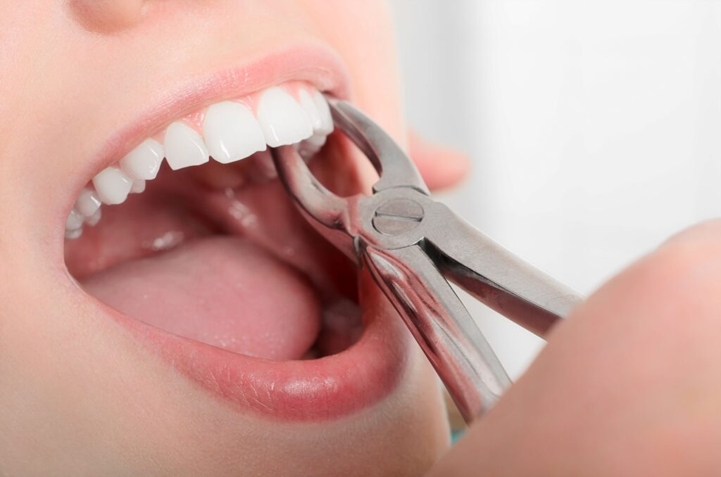 Forceps grasping a woman's tooth for extraction